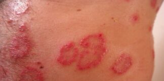 łojotokowe zapalenie skóry